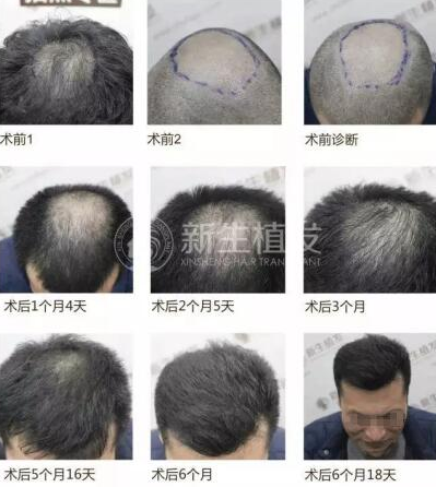 南京植发医院排名|南京种植头发哪家好?附植发案例+价格表