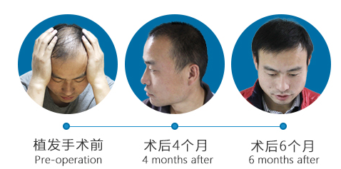 上海正规植发医院排行榜|大麦微针、帝妍植发、新生植发等上榜!