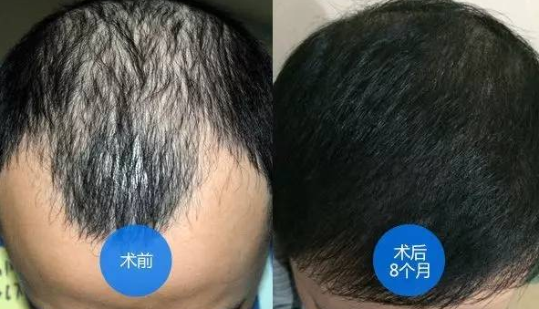 北京南加种植头发好不好?附秃顶植发经历分享+医院价格表