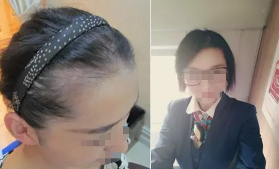 福州大麦微针植发怎么样?附医生介绍+秃头女孩的植发经历分享