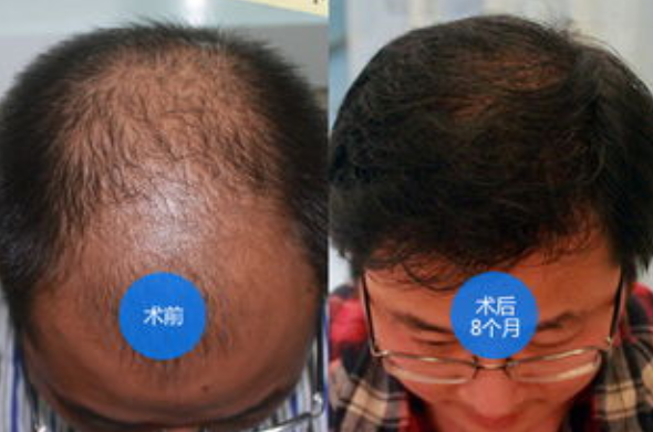 南昌碧莲盛植发靠谱吗?效果怎么样?附大面积植发经历分享