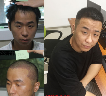 广州植发组团(广州排名前十的植发医院)