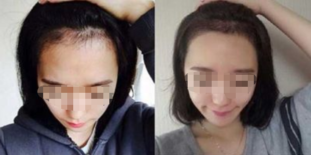 重庆华美植发医院怎么样?附地址_医生介绍_植发际线案例
