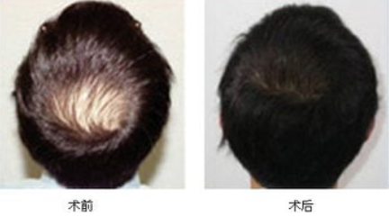 深圳青逸植发医院怎么样?附地址_医生介绍_脱发植发案例分享