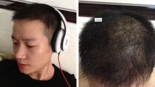 上海雍禾植发机构正规吗?附医生介绍_植发案例_价格表