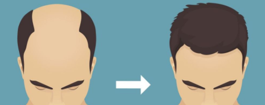 植发靠不靠谱，植发后的效果一般能维持多久