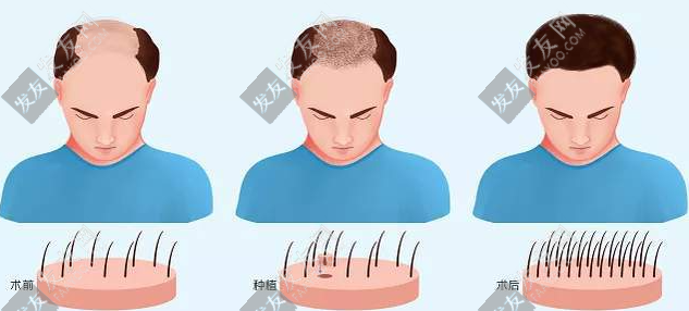 种头发和植发