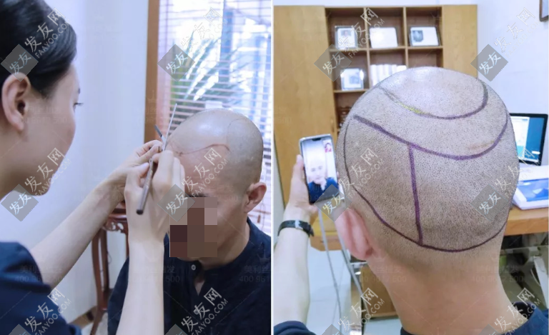 德州植發醫院哪家好？醫院排名及科普植發多少錢
